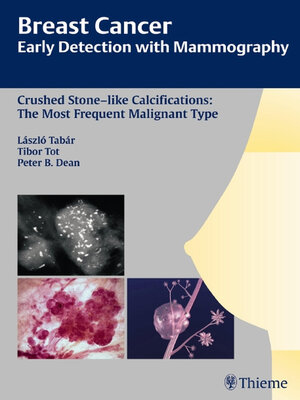 cover image of Breast Cancer